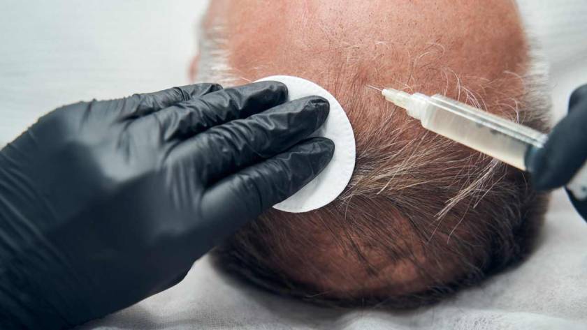 Stem Cells For Hair Loss