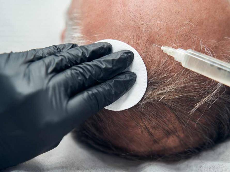 Stem Cells For Hair Loss
