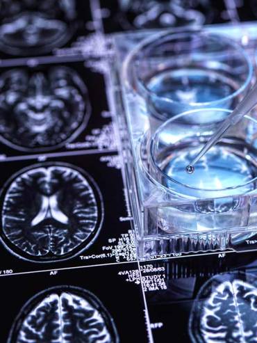 Stem Cell Therapy for Multiple Sclerosis