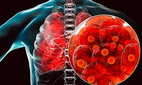 Post Covid Stem CEll therapy